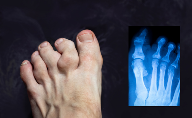 Broken Toe Causes Treatment And Recovery Tips