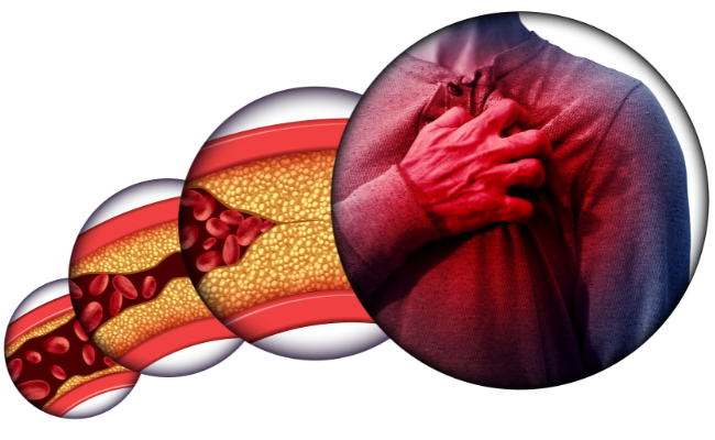 How to Treat Ischaemic Heart Disease Atherosclerosis?