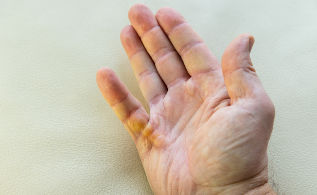 How to Treat Dupuytrens Contracture?