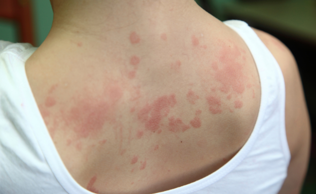 How to Treat Dermatitis Herpetiformis?