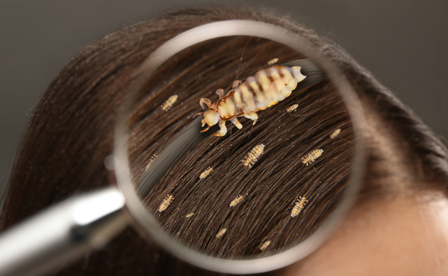 How to Treat Head Lice And Nits?