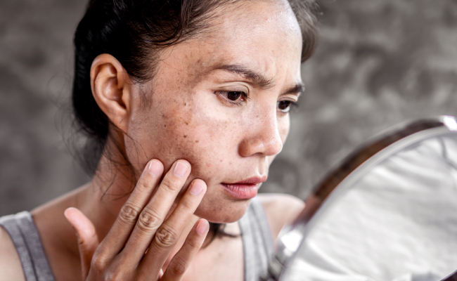 How to Treat Hyperpigmentation?