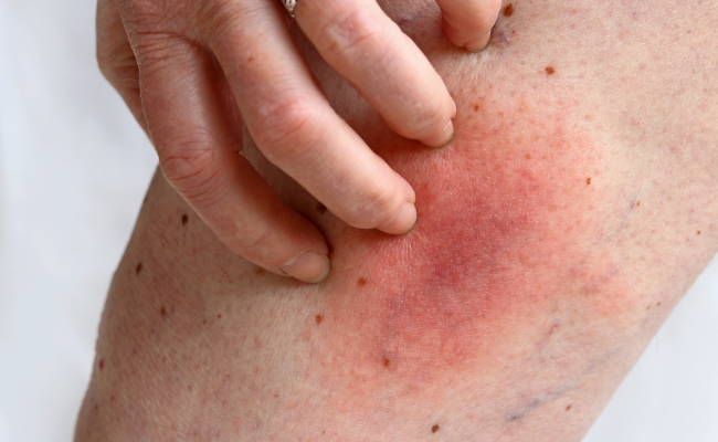 How to Treat Rashes?