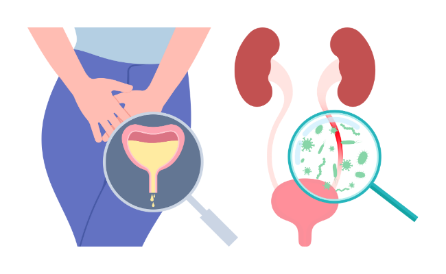 How to Treat Urinary Tract Infection?