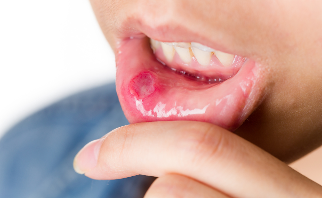 How to Treat Mouth Ulcers?