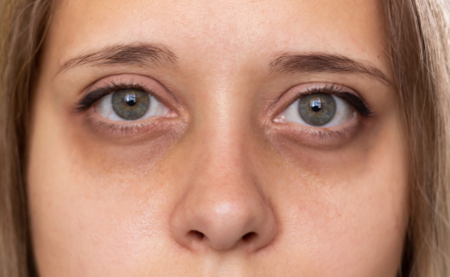 Dark circles : Causes and Solutions