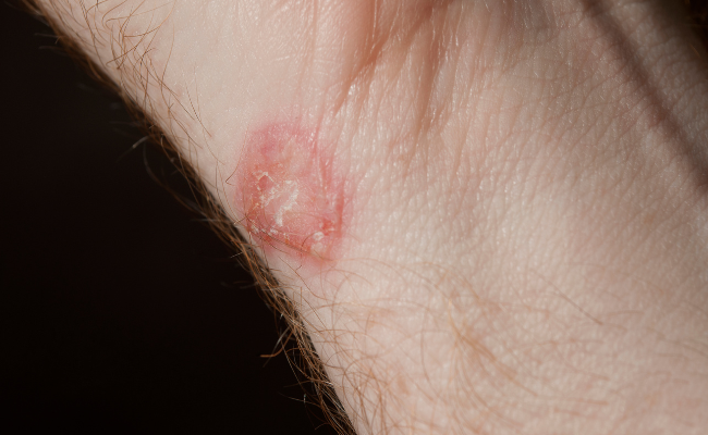 How to Treat Ringworm?