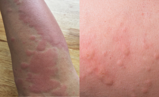 How to Treat Hives?