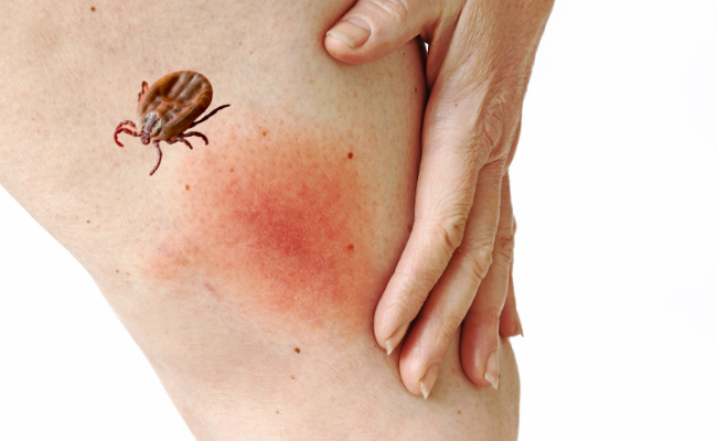 How to Treat Lyme Disease?