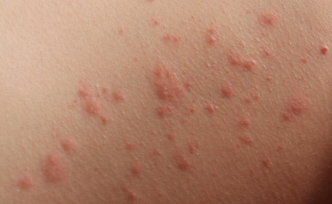 How to Treat Contact Dermatitis?