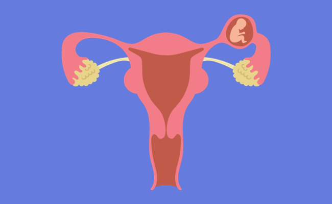 How to Treat Ectopic Pregnancy?