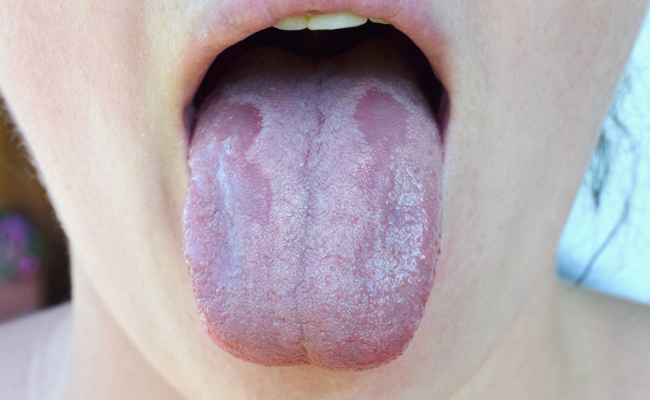 How to Treat White Tongue?