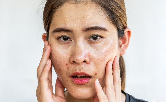 How to Treat Oily Skin?