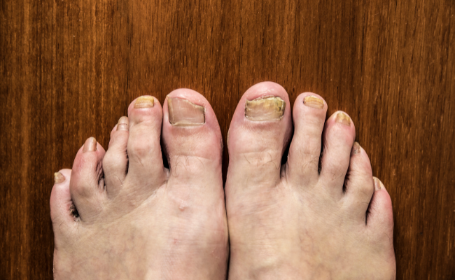 How to Treat Fungal Nail Infection?