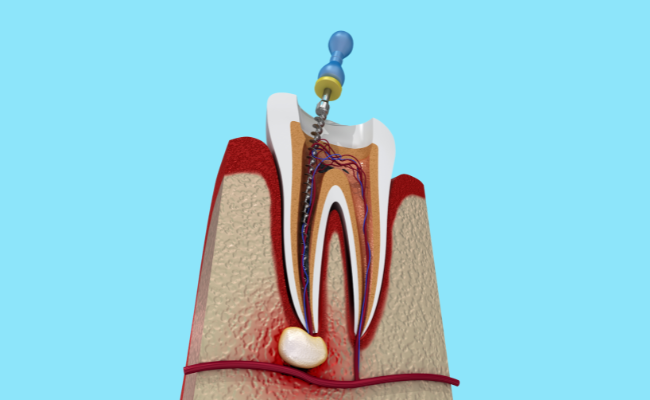 How to Treat Root Canal?