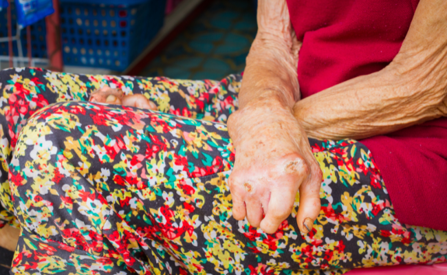 How to Treat Leprosy?