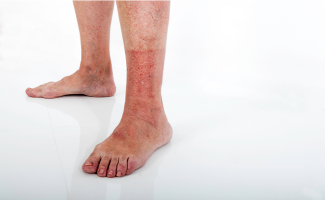 How to Treat Acid And Chemical Burns?