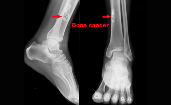 What to do incase of  Bone Cancer?