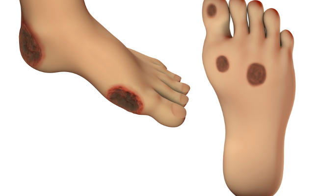 How to Treat Diabetic Foot Ulcers?