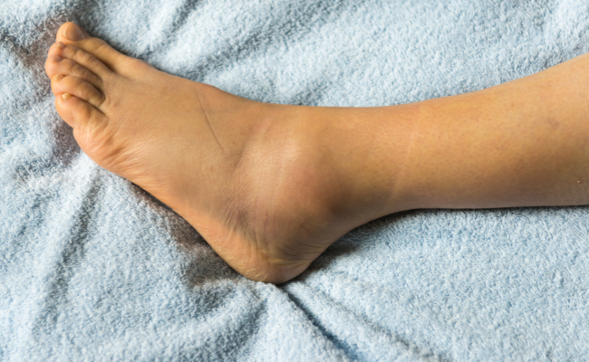 How to Treat Swollen Ankles?