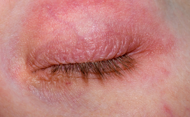 Eyelid Dermatitis Causes Symptoms And Management