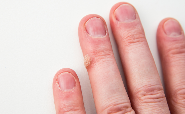 How to Treat Scleroderma?