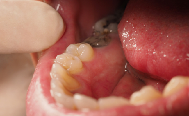 How to Treat Tooth Decay?