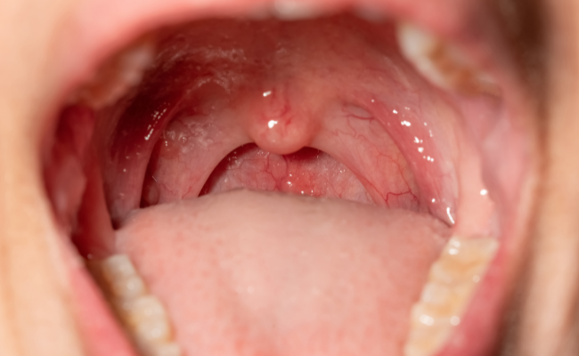 How to Treat Pharyngitis?