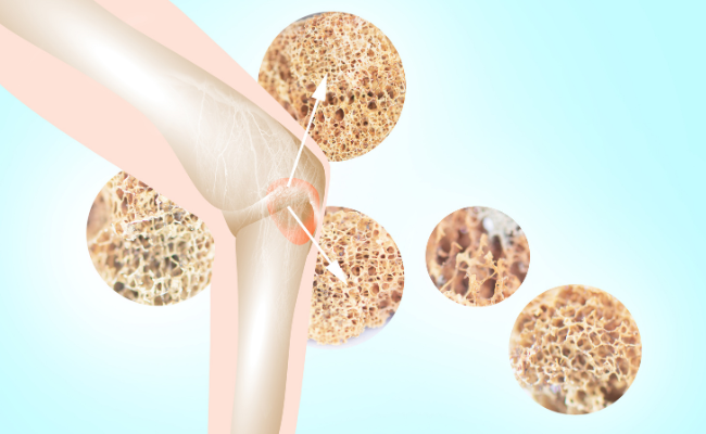 How to Treat Osteoporosis?