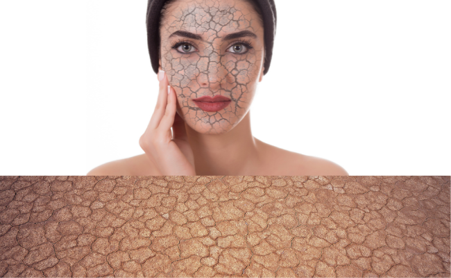 How to Treat Xerosis?