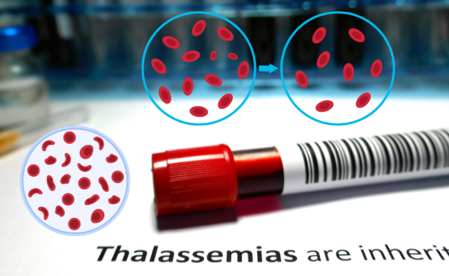 How to Treat Thalassemia?