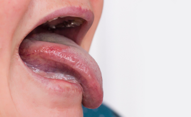 How to Treat Leukoplakia?