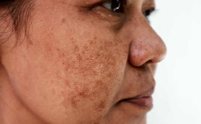 How to Treat Melasma?