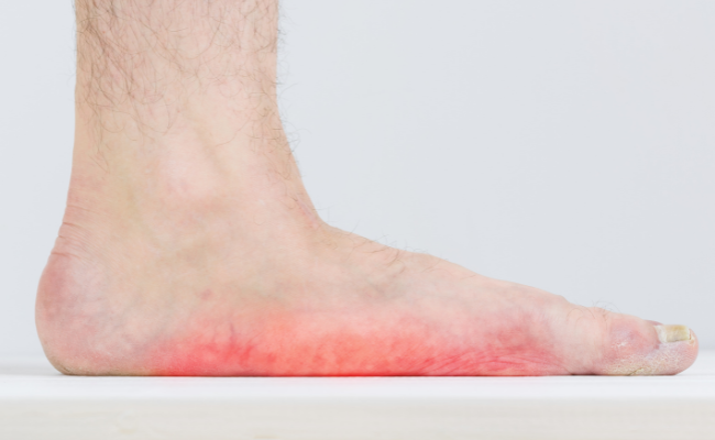 How to Treat Flat Feet?