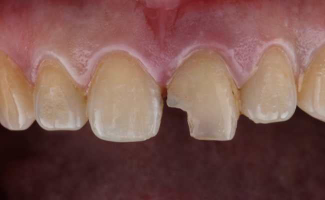 How to Treat Chipped Tooth?