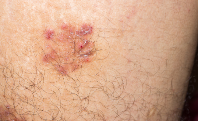 How to Treat Pemphigus Vulgaris?