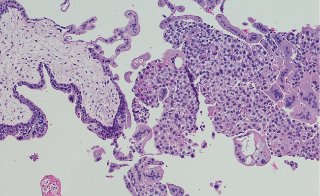 How to Treat Trophoblastic Neoplasia?