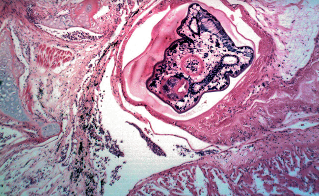 How to Treat Isosporiasis?