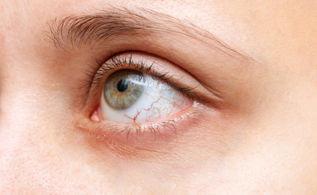 How to Treat Uveitis?