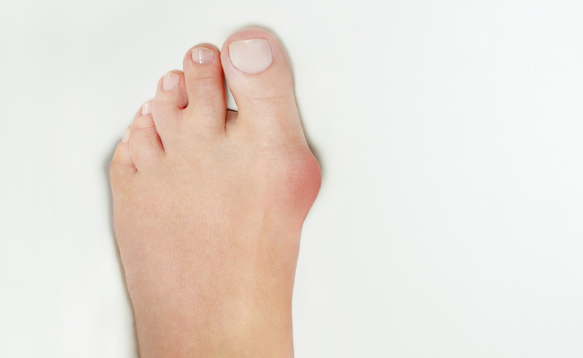 How to Treat Bunions?