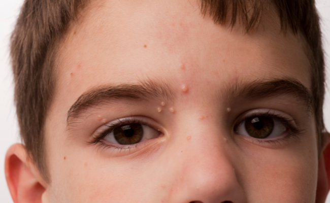How to Treat Molluscum Contagiosum?