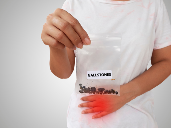 How to Treat Gall Stones?