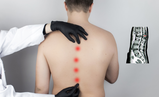 How to Treat Kyphosis?