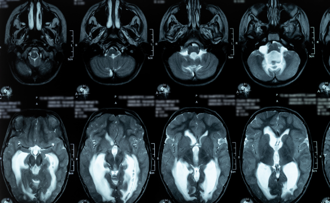 How to Treat Hydrocephalus?