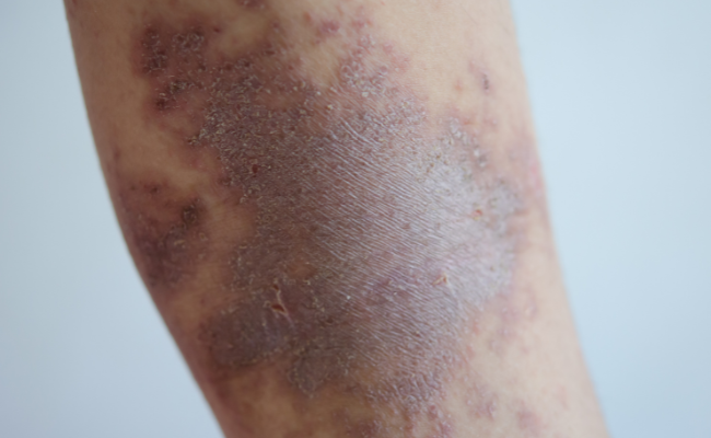 How to Treat Kaposis Sarcoma?