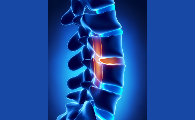 How to Treat Osteophyte?