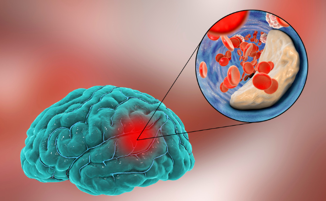 How to Treat Transient Ischaemic Attack?