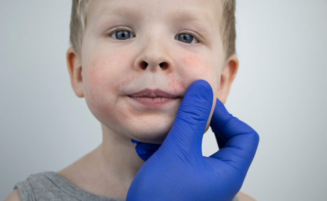 Slapped Cheek Syndrome Causes Symptoms And Care