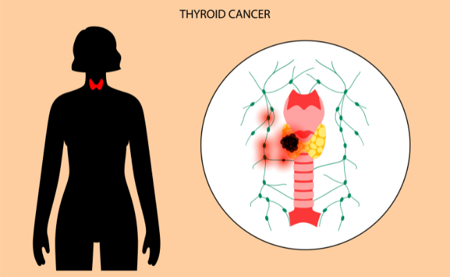 What to do incase of  Thyroid Cancer?