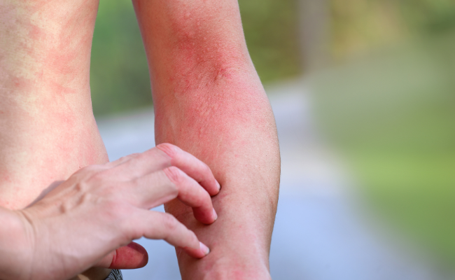 How to Treat Dermatomyositis?